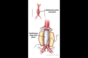 Vascular Surgeries
