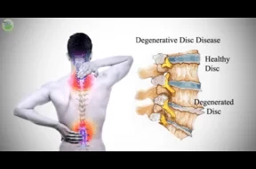 Spinal Degenerative Disease