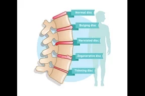 Spinal Degenerative Disease