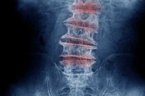 spinal-degenerative-disease