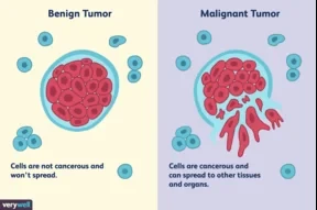 Malignant tumors embody the intricate complexity of cancer