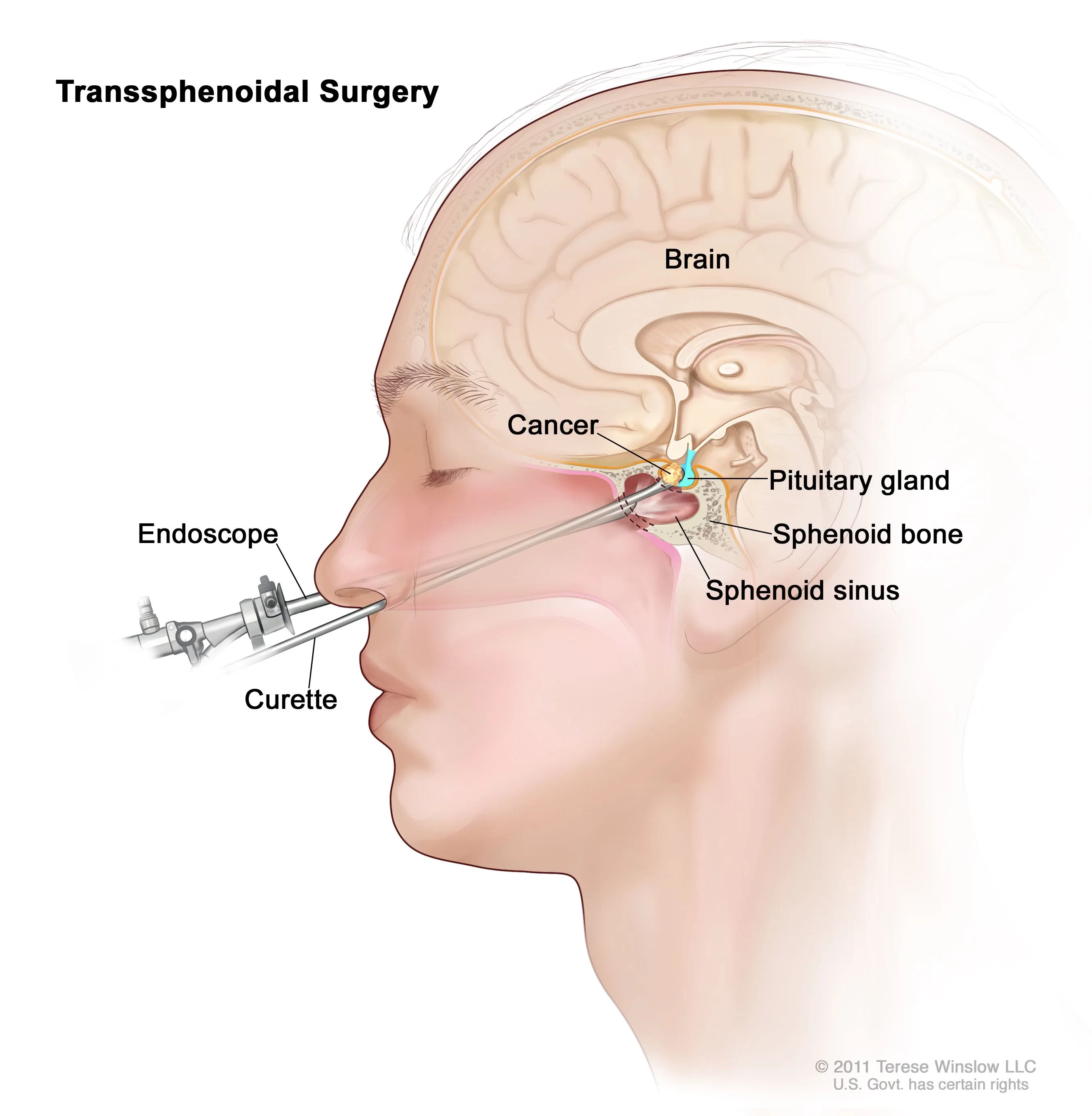 pituitary-tumour