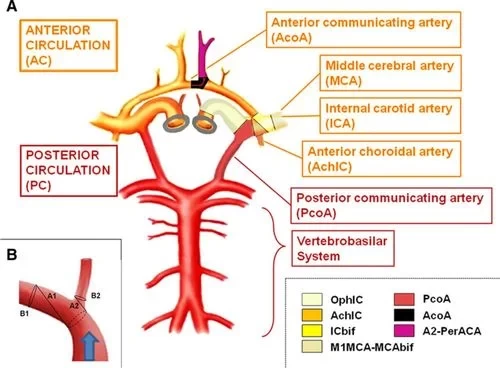 anterior-circulation-aneurysm