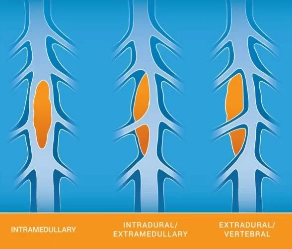 spinal-intradural-extramedullary