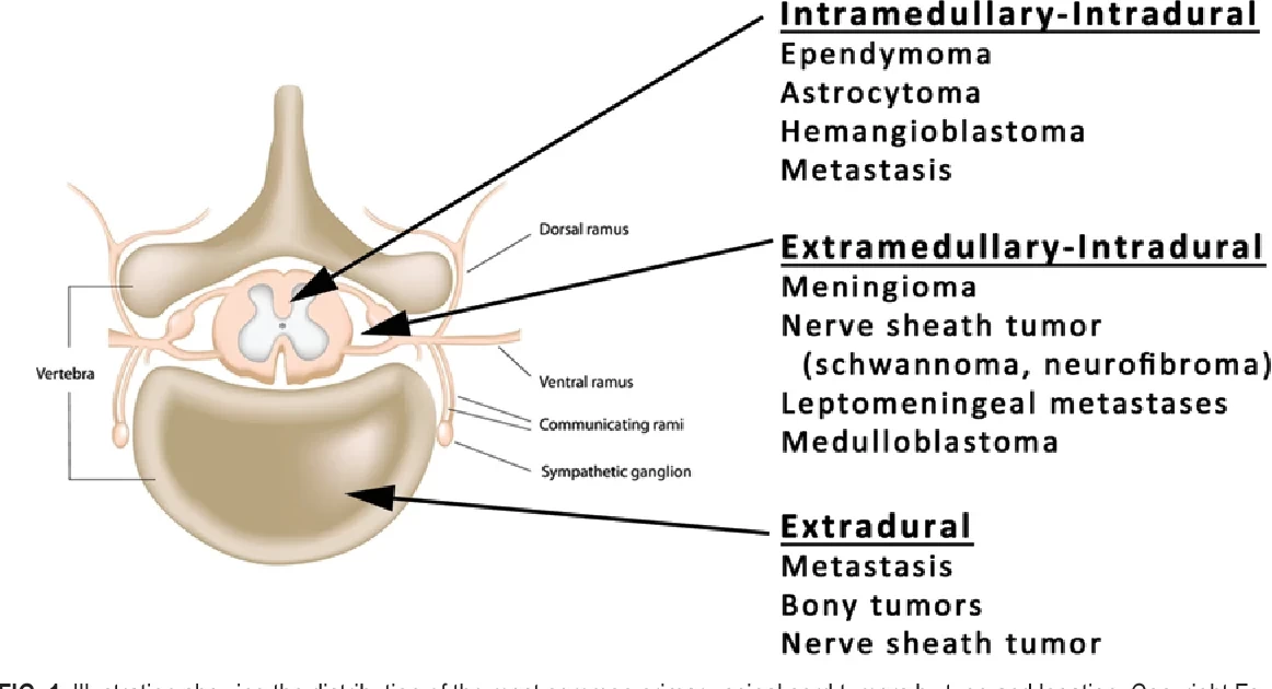 spinal-intradural-extramedullary