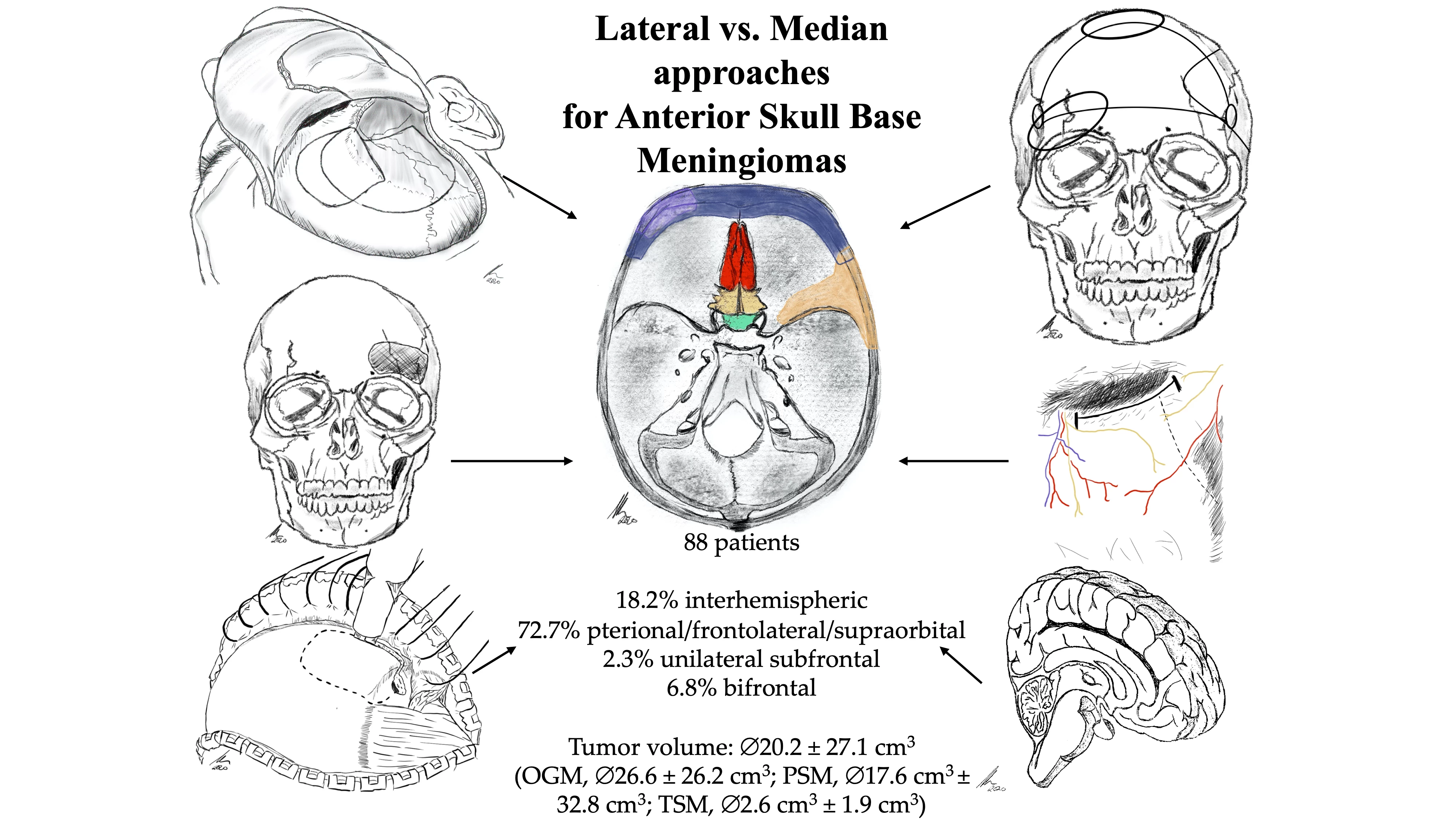 frontal-base-meningioma